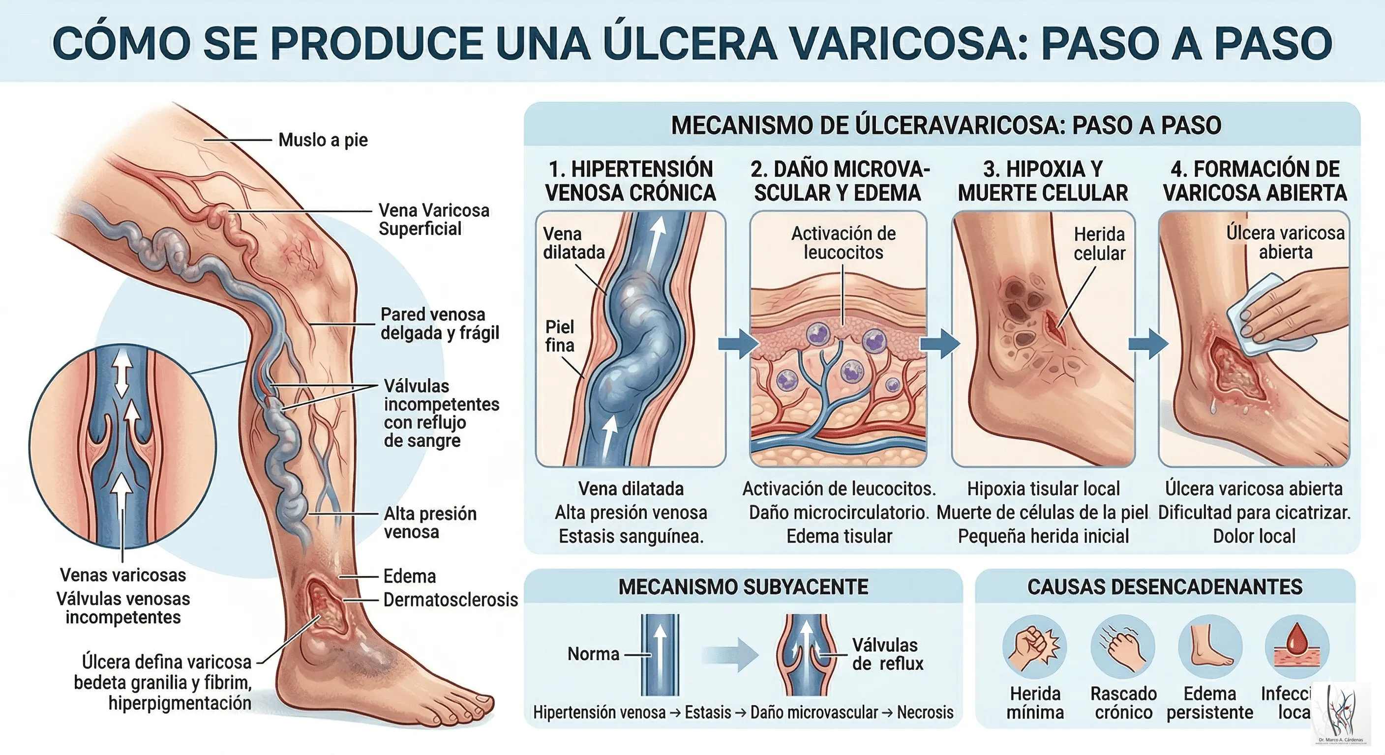 Úlcera Varicosa